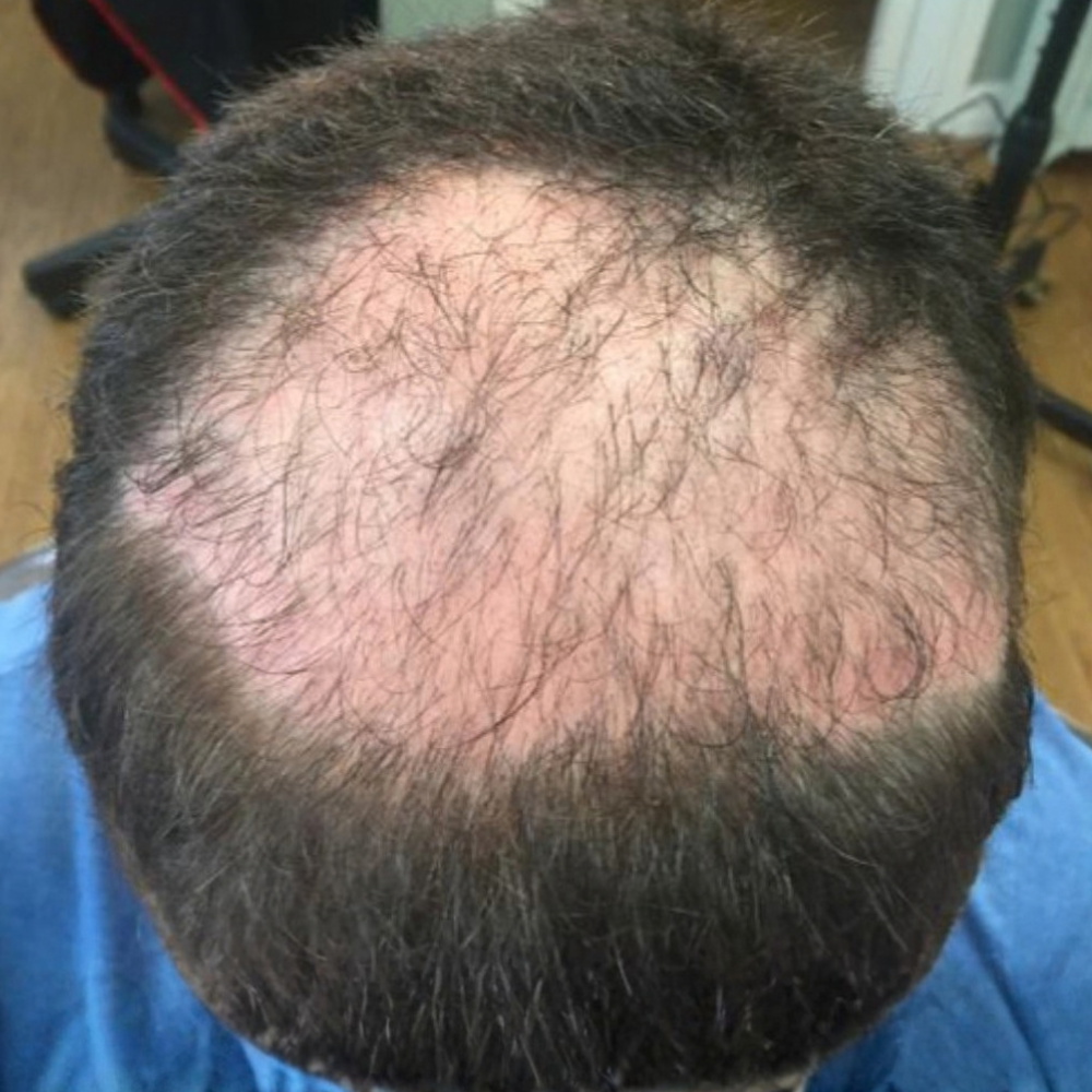 Scalp of a 26 year old client before treatment for alopecia areata