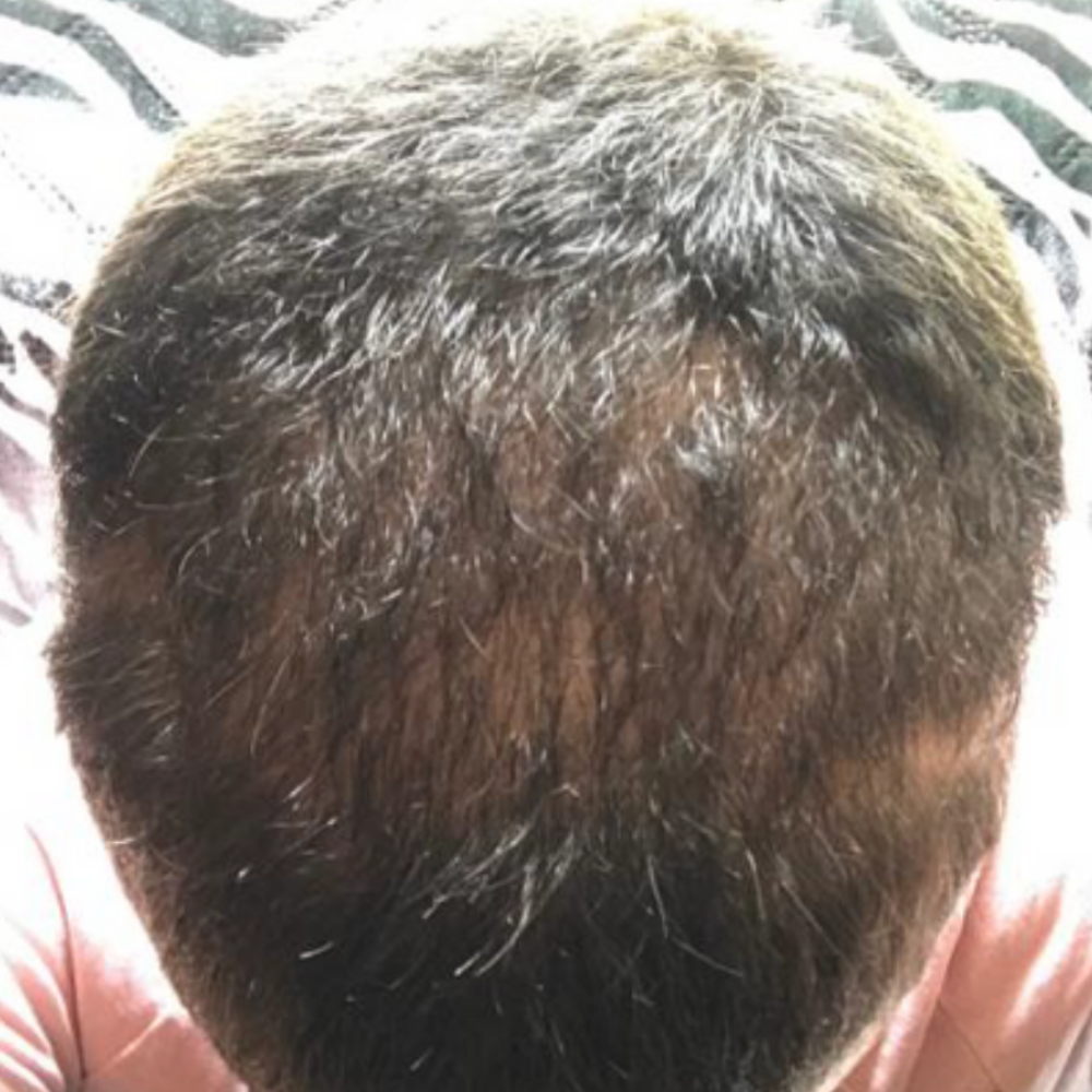 The same client after five weeks of trichology care with regrowth across the scalp
