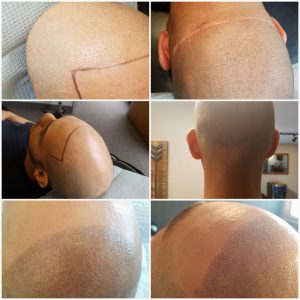 ScalpMicropigmentation Before and After
